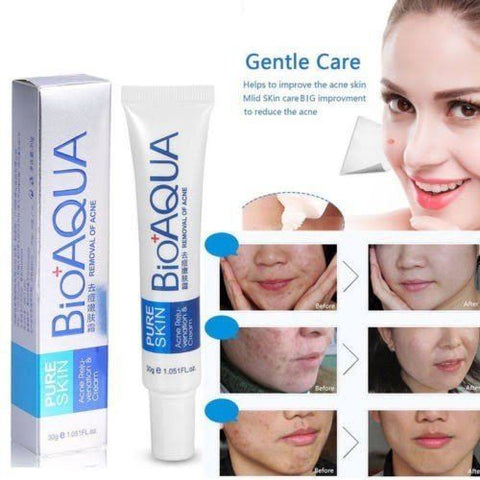 Anti Acne Cream